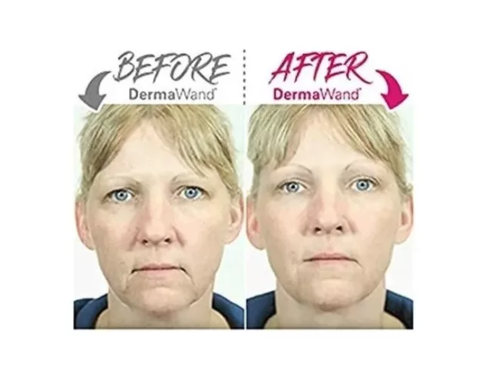 Tonificador Facial con Radiofrecuencia | Lifting y Rejuvenecimiento en Casa