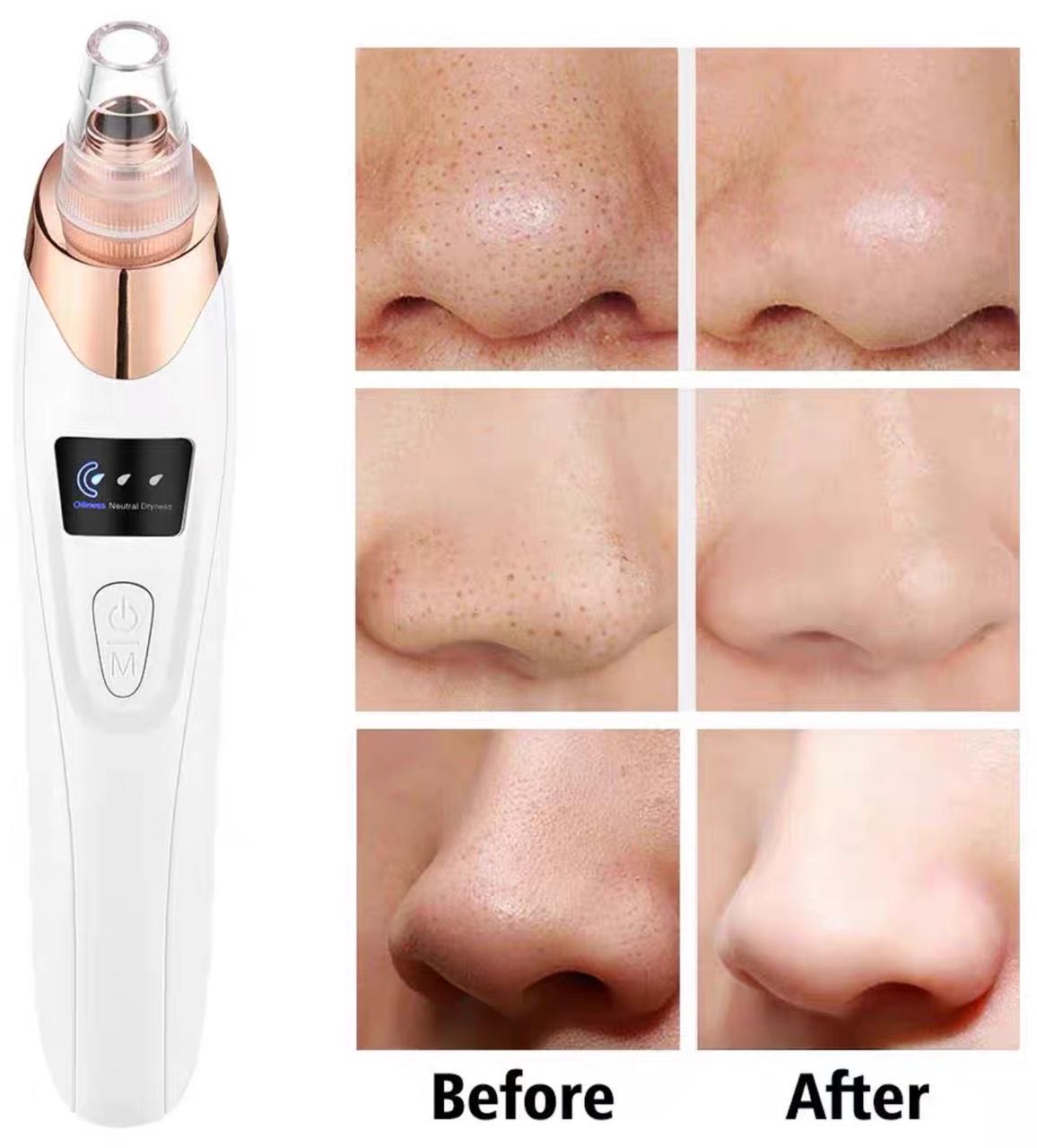 Aspiradora Extractora de Puntos Negros | Limpieza Facial Profunda